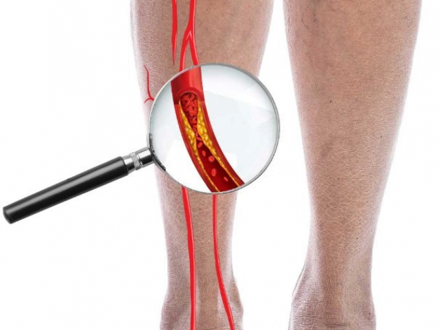 Peripheral Artery Disease